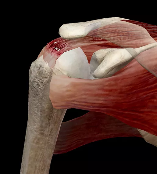 Rotator Cuff Tear
